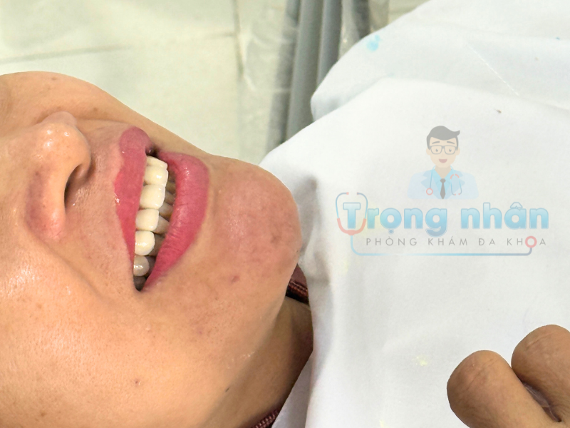 Răng sứ thẩm mỹ là gì