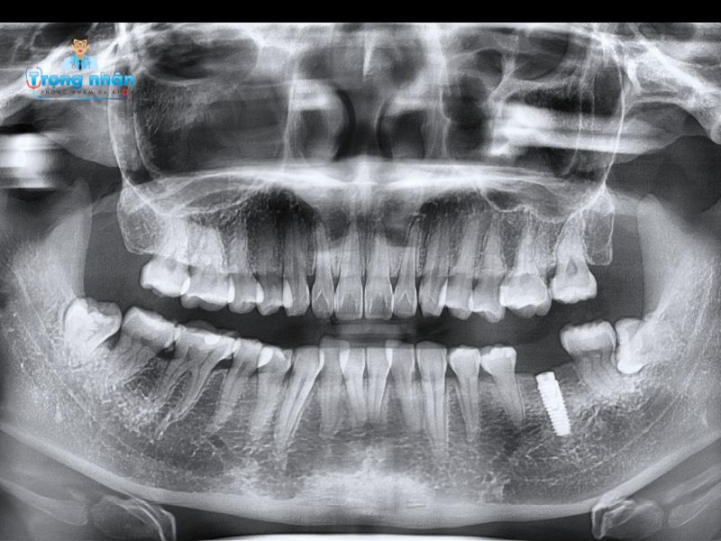 Cấy ghép implant