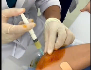 Điều trị thoái hóa khớp bằng huyết tương giàu tiểu cầu (PRP)