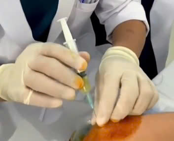 điều trị thoái hóa khớp bằng huyết tương giàu tiểu cầu (PRP)