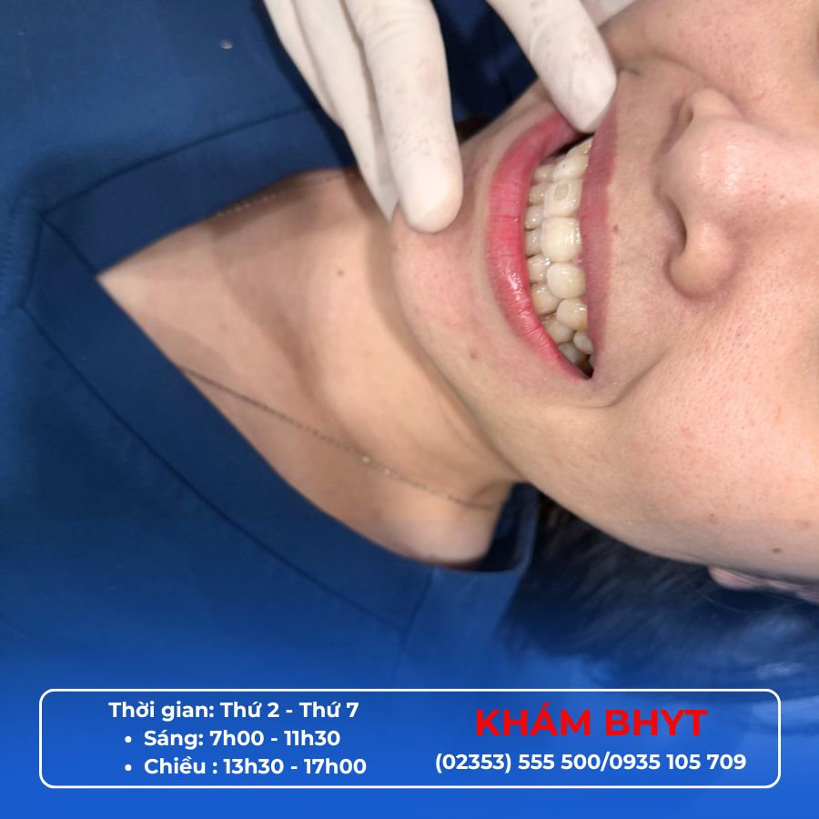 Niềng răng có phải nhổ răng không