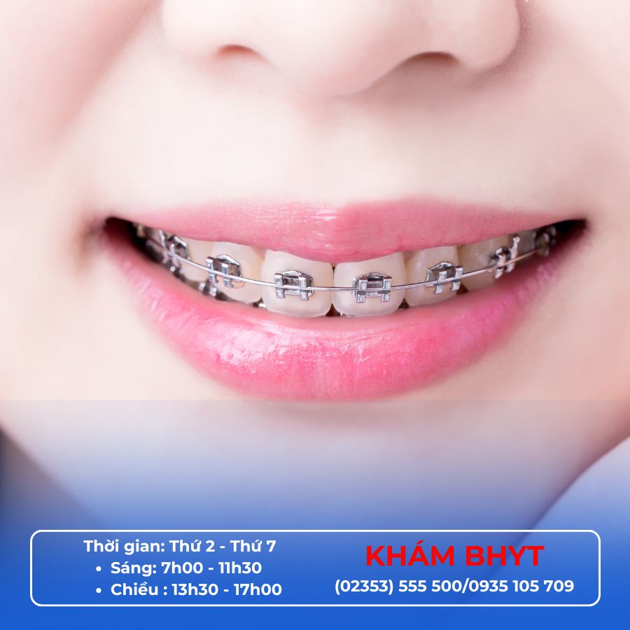 Niềng răng có phải nhổ răng