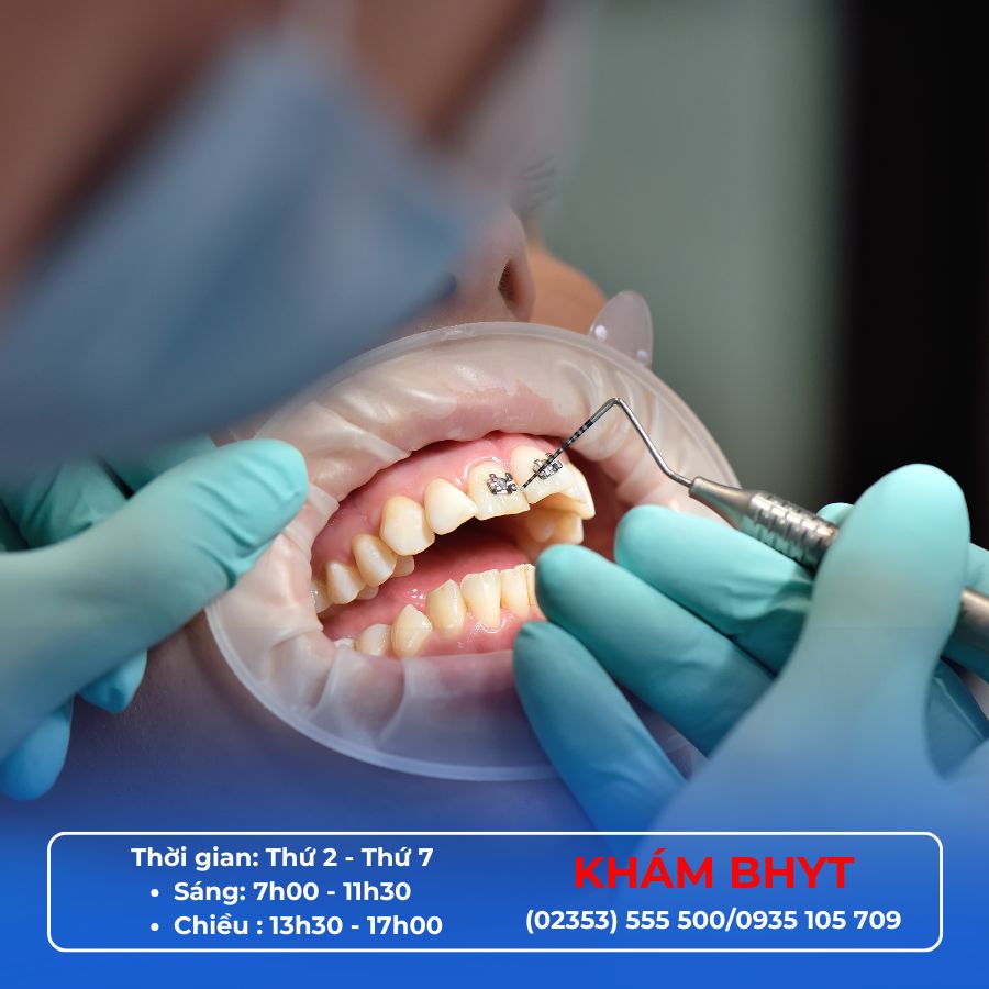 Niềng răng có phải nhổ răng không