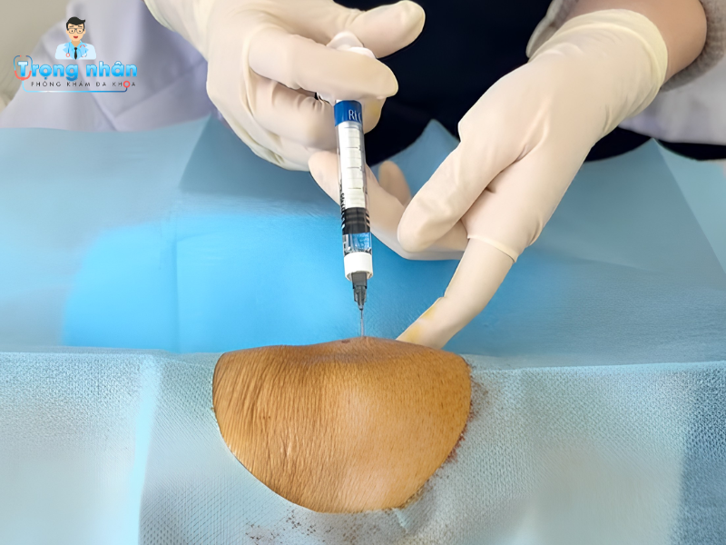 Tiêm chất nhờn khớp gối