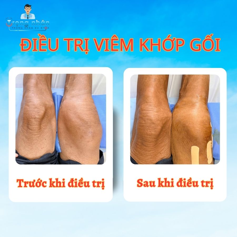 Điều trị tràn dịch khớp gối