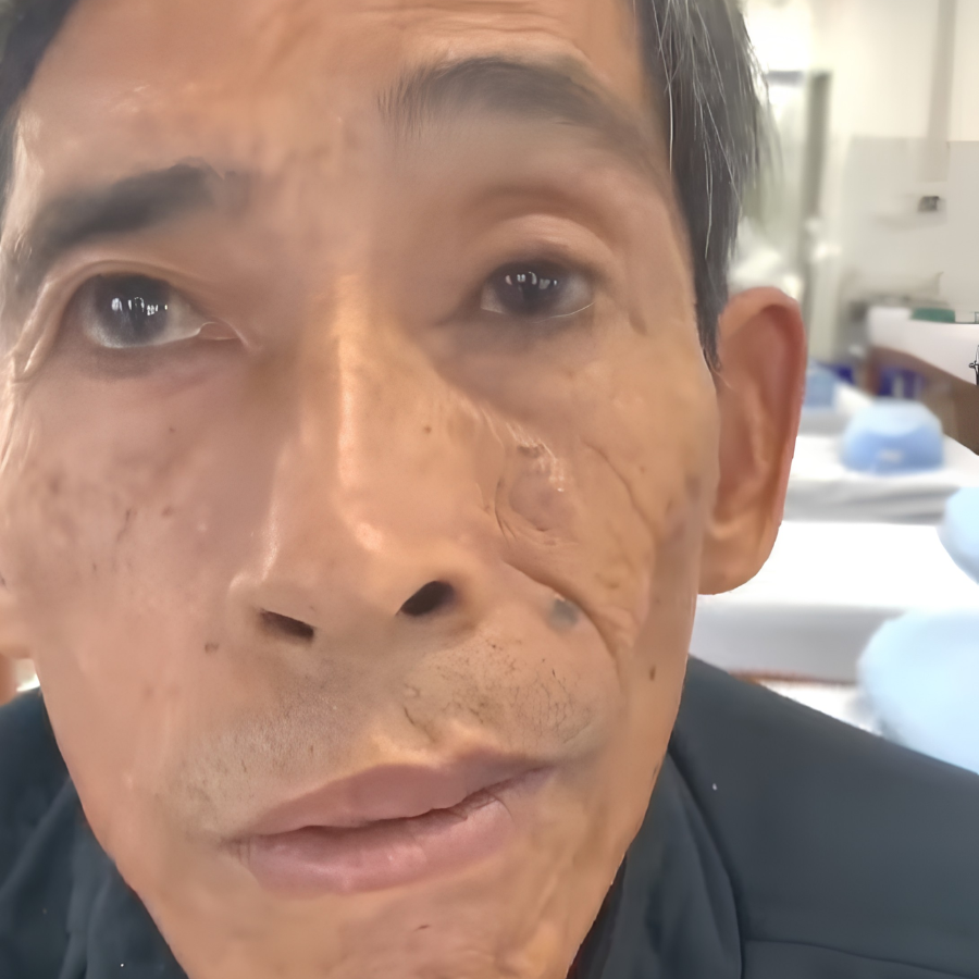 Liệt mặt là gì?
