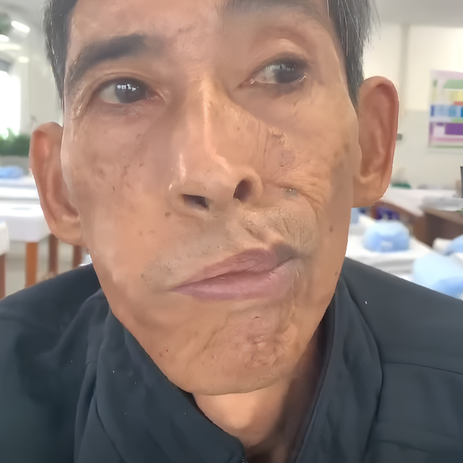 Liệt mặt là gì?