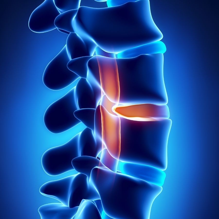 Thoát vị đĩa đệm cột sống thắt lưng
