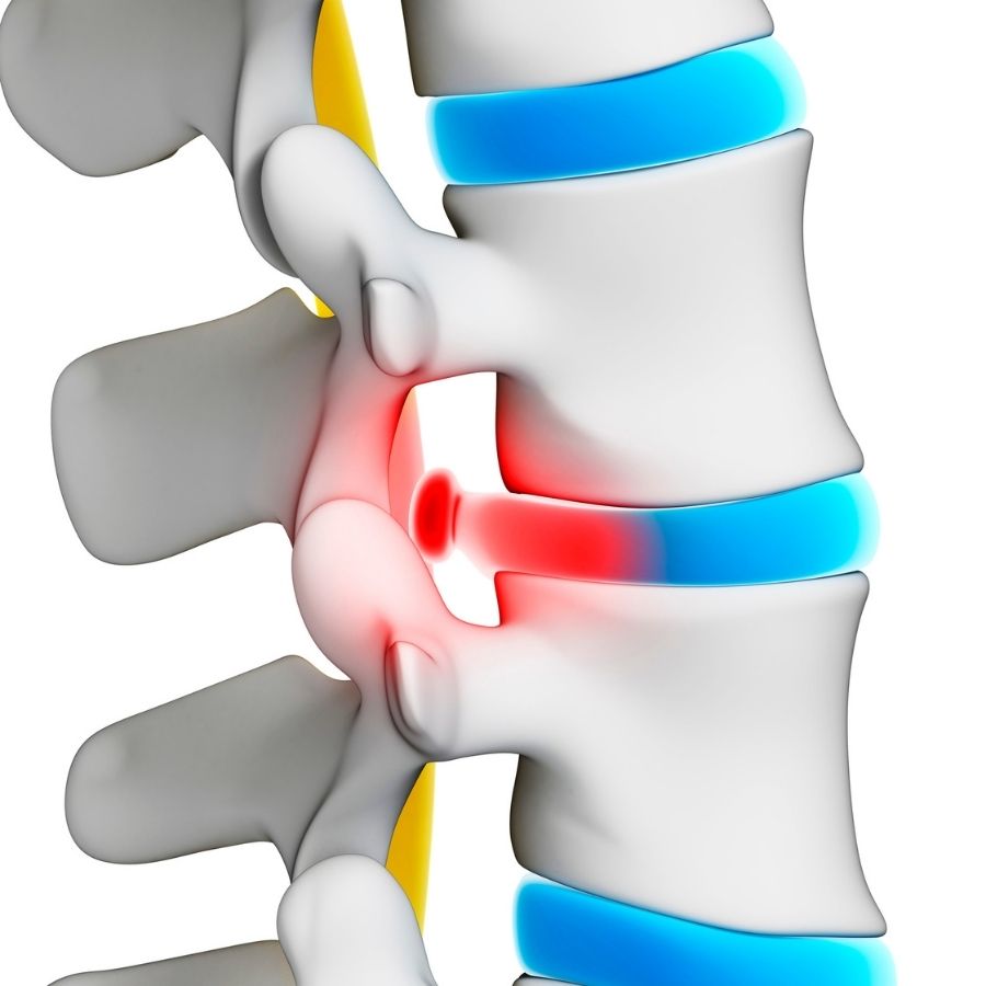Thoát vị đĩa đệm cột sống thắt lưng