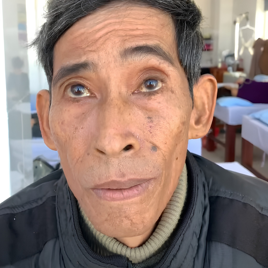 Liệt mặt là gì?