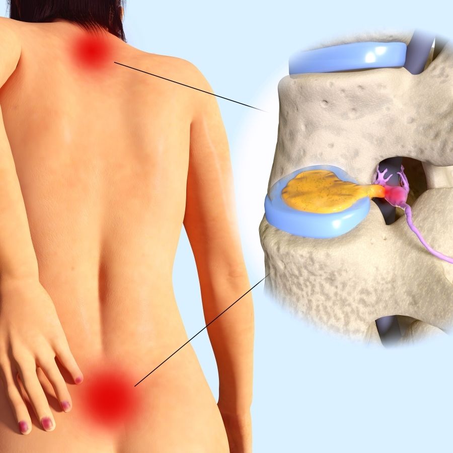 Thoát vị đĩa đệm cột sống thắt lưng